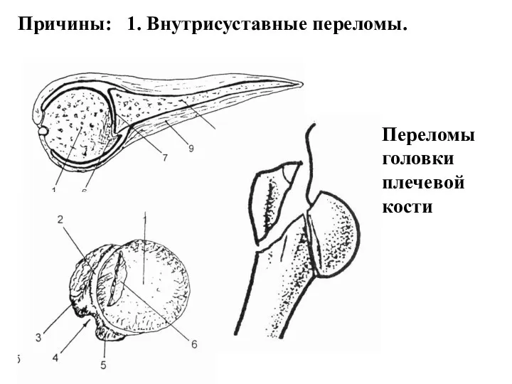 Причины: 1. Внутрисуставные переломы. Переломы головки плечевой кости