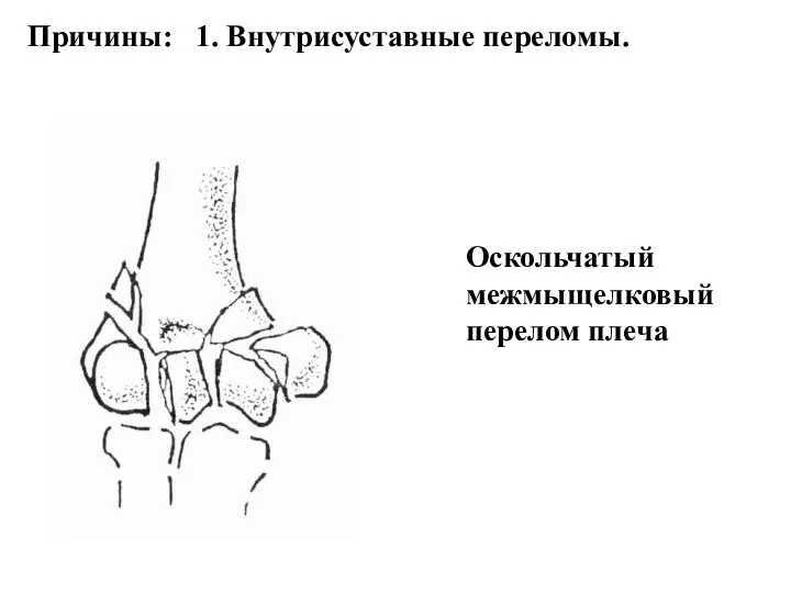 Причины: 1. Внутрисуставные переломы. Оскольчатый межмыщелковый перелом плеча