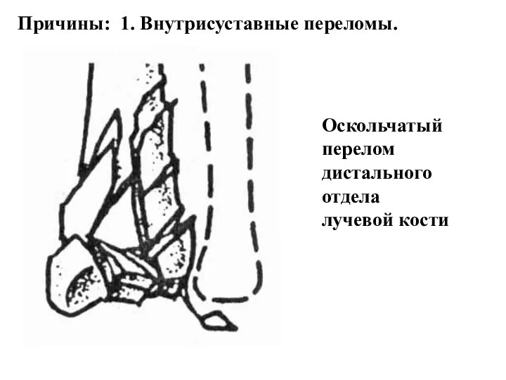 Причины: 1. Внутрисуставные переломы. Оскольчатый перелом дистального отдела лучевой кости