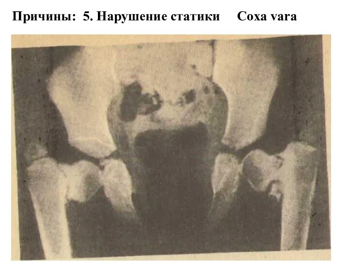 Причины: 5. Нарушение статики Coxa vara