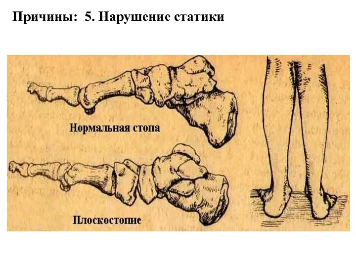 Причины: 5. Нарушение статики