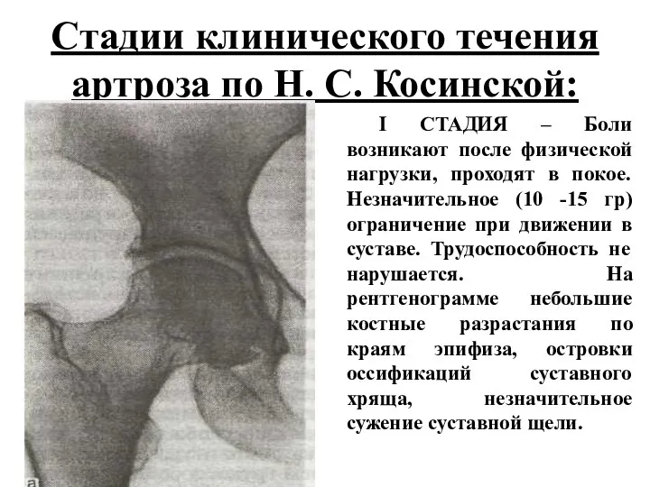 Стадии клинического течения артроза по Н. С. Косинской: I СТАДИЯ