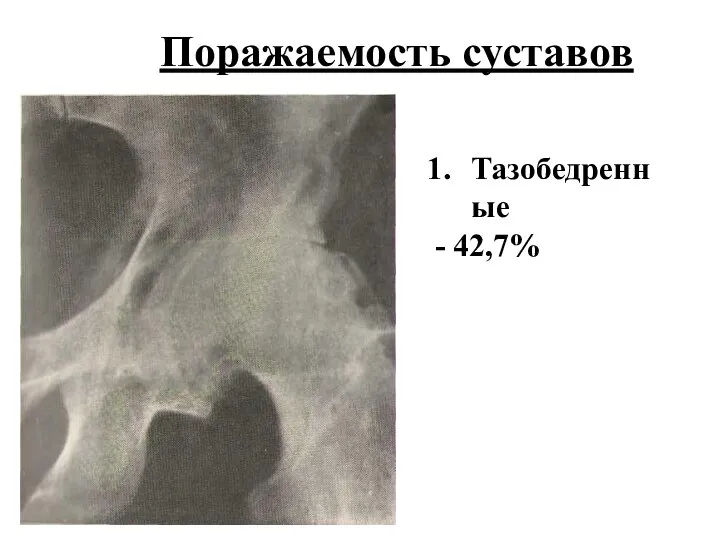 Поражаемость суставов Тазобедренные - 42,7%