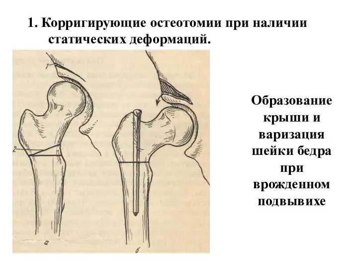 1. Корригирующие остеотомии при наличии статических деформаций. Образование крыши и варизация шейки бедра при врожденном подвывихе