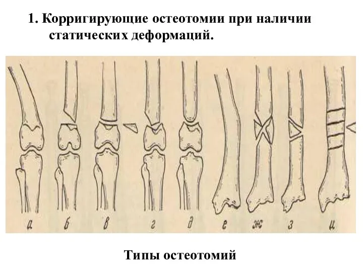 1. Корригирующие остеотомии при наличии статических деформаций. Типы остеотомий