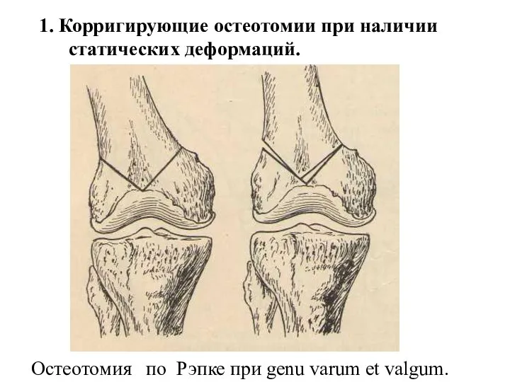 1. Корригирующие остеотомии при наличии статических деформаций. Остеотомия по Рэпке при genu varum et valgum.