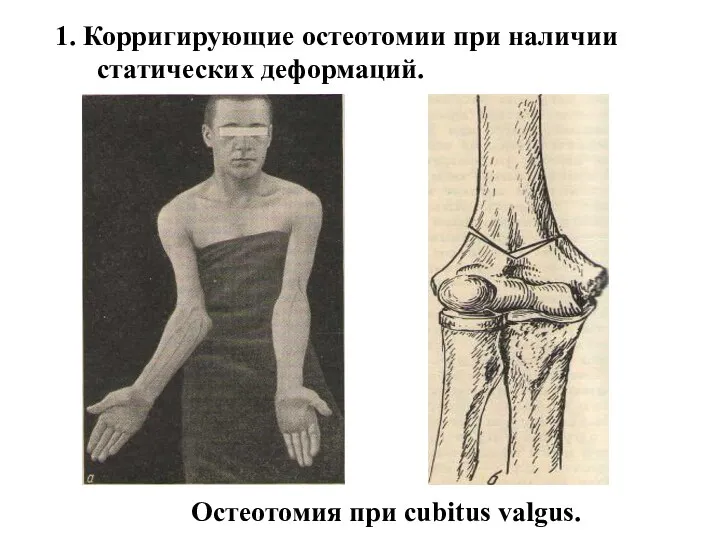 1. Корригирующие остеотомии при наличии статических деформаций. Остеотомия при cubitus valgus.