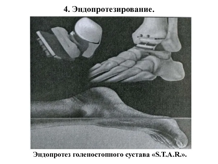 4. Эндопротезирование. Эндопротез голеностопного сустава «S.T.A.R.».