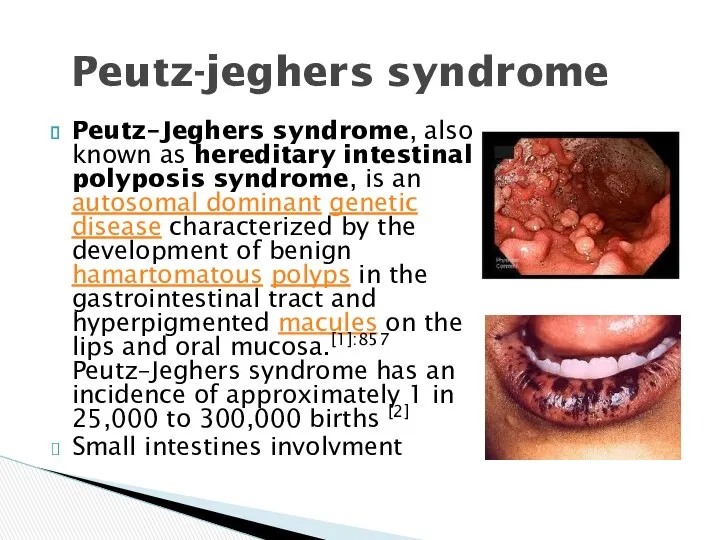 Peutz–Jeghers syndrome, also known as hereditary intestinal polyposis syndrome, is an autosomal dominant
