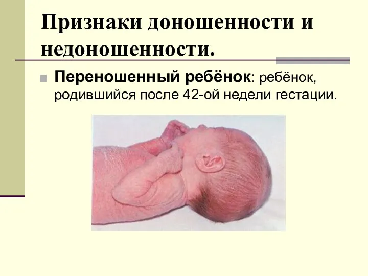 Переношенный ребёнок: ребёнок, родившийся после 42-ой недели гестации. Признаки доношенности и недоношенности.