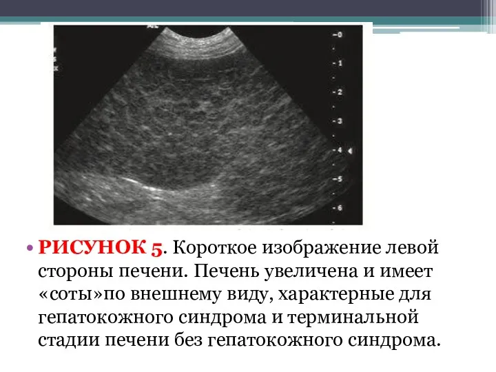 РИСУНОК 5. Короткое изображение левой стороны печени. Печень увеличена и