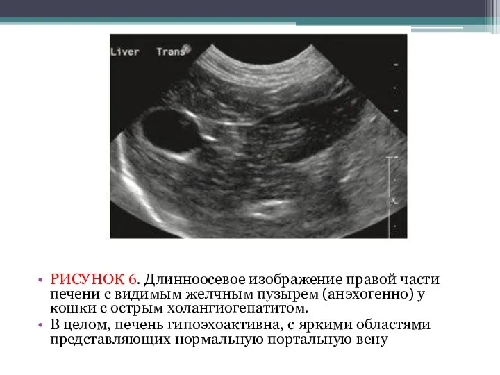 РИСУНОК 6. Длинноосевое изображение правой части печени с видимым желчным