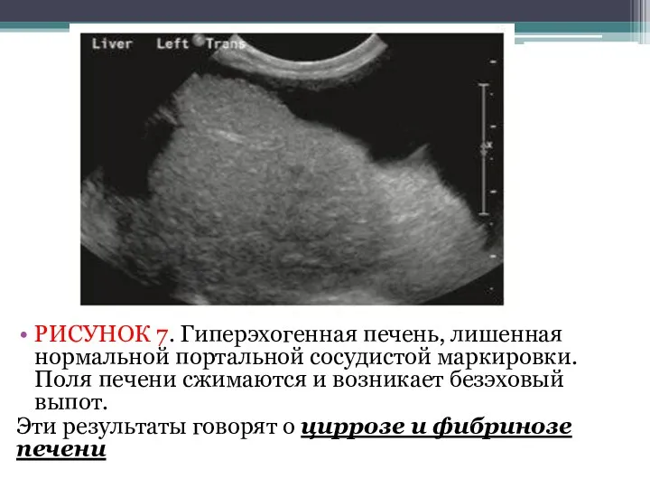 РИСУНОК 7. Гиперэхогенная печень, лишенная нормальной портальной сосудистой маркировки. Поля