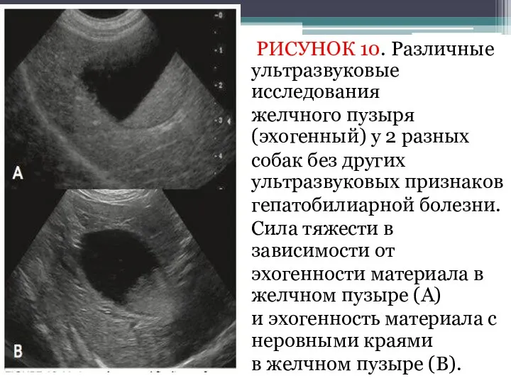 РИСУНОК 10. Различные ультразвуковые исследования желчного пузыря (эхогенный) у 2