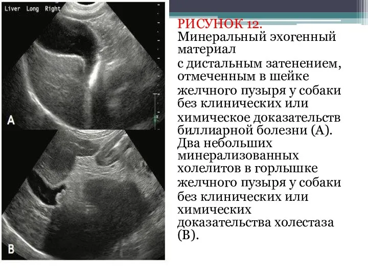 РИСУНОК 12. Минеральный эхогенный материал с дистальным затенением, отмеченным в