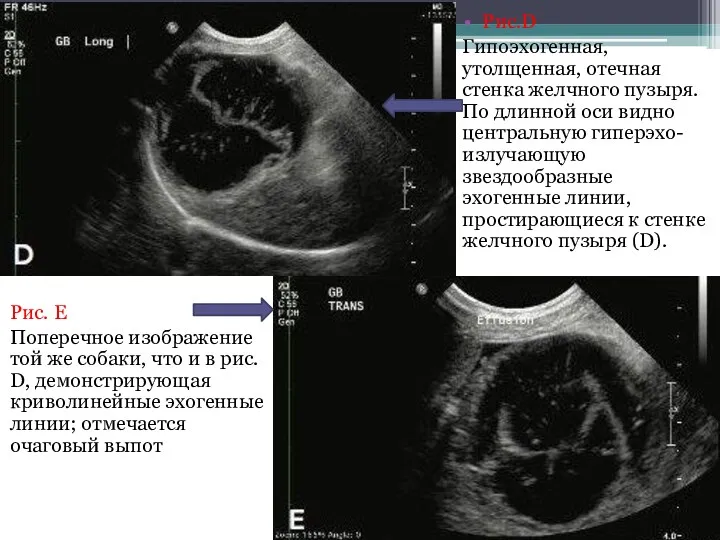 Рис.D Гипоэхогенная, утолщенная, отечная стенка желчного пузыря. По длинной оси