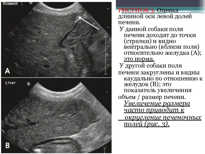 РИСУНОК 3. Оценка длинной оси левой долей печени. У данной