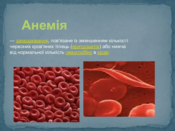 — захворювання, пов'язане із зменшенням кількості червоних кров'яних тілець (еритроцитів) або нижча від