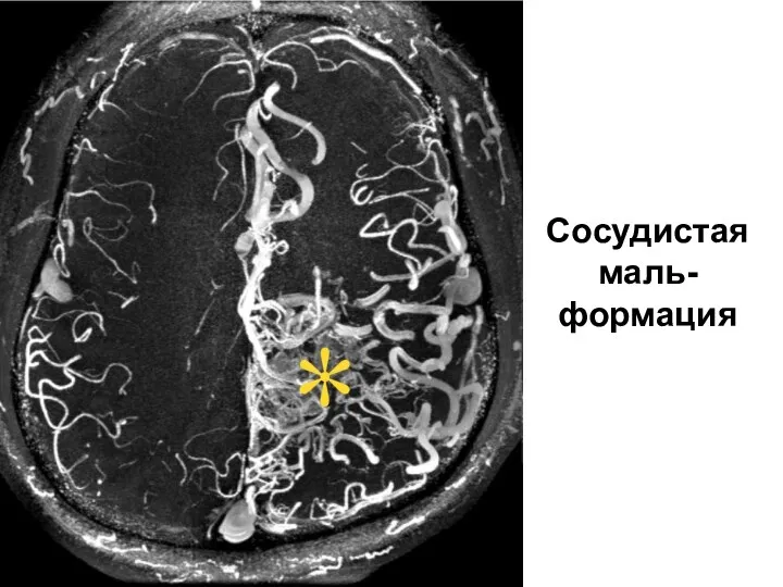 Сосудистая маль-формация