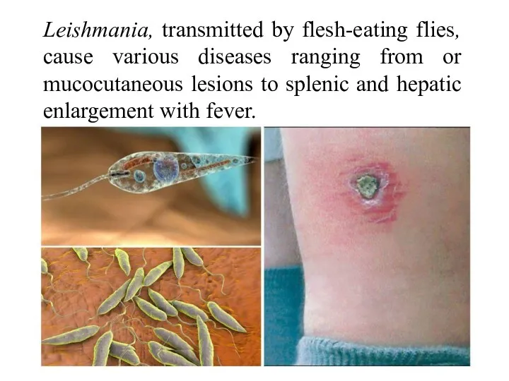 Leishmania, transmitted by flesh-eating flies, cause various diseases ranging from or mucocutaneous lesions