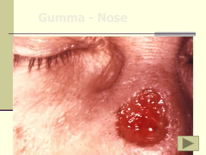 Gumma - Nose