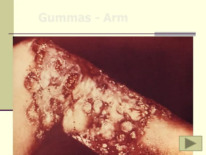 Gummas - Arm