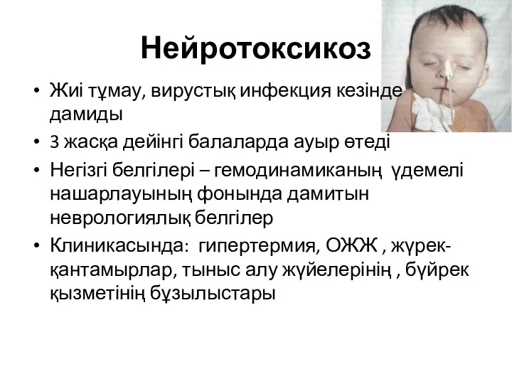 Нейротоксикоз Жиі тұмау, вирустық инфекция кезінде дамиды 3 жасқа дейінгі