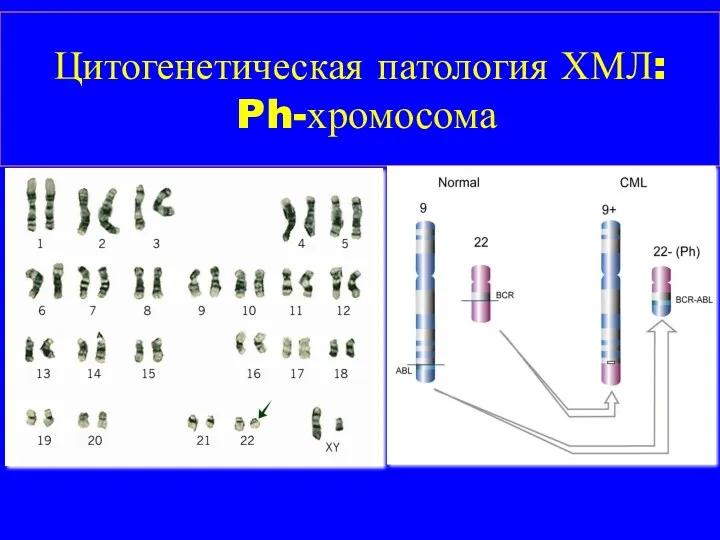 Цитогенетическая патология ХМЛ: Ph-хромосома