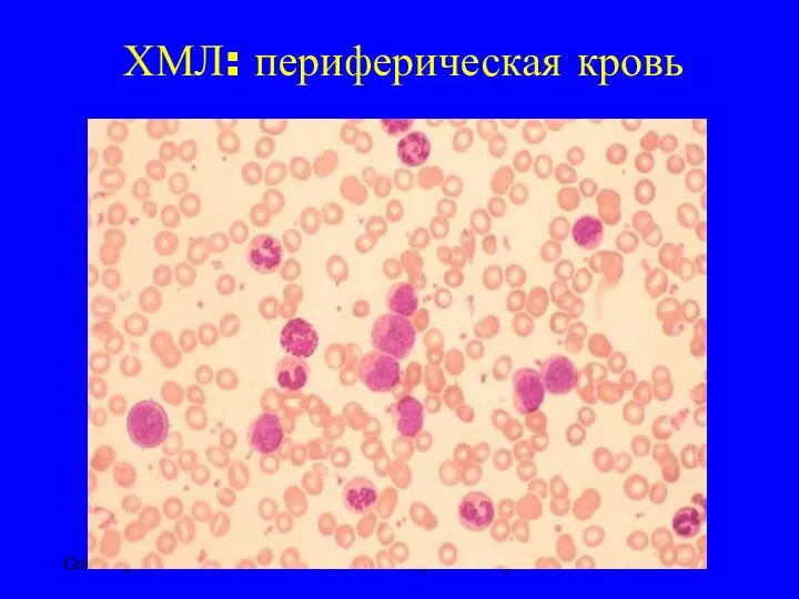 ХМЛ: периферическая кровь Courtesy of John K. Choi, MD, PhD, University of Pennsylvania.