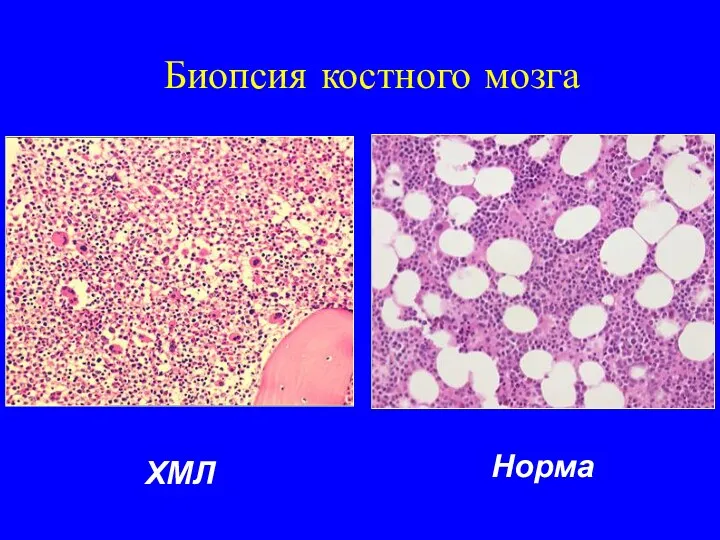 Биопсия костного мозга ХМЛ Норма