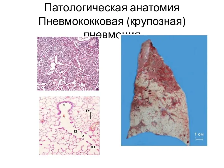 Патологическая анатомия Пневмококковая (крупозная) пневмония