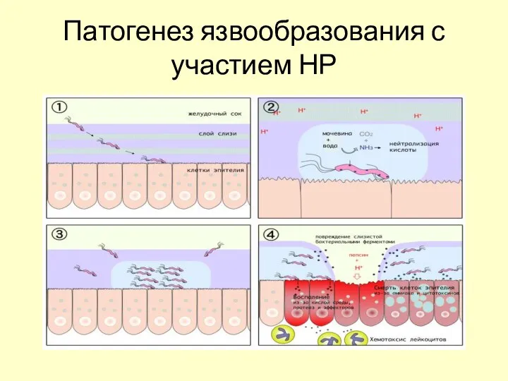 Патогенез язвообразования с участием НР