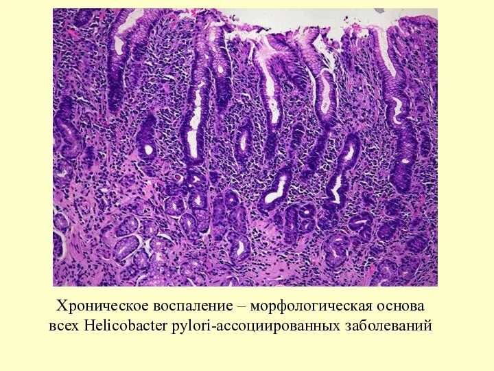 Хроническое воспаление – морфологическая основа всех Helicobacter pylori-ассоциированных заболеваний