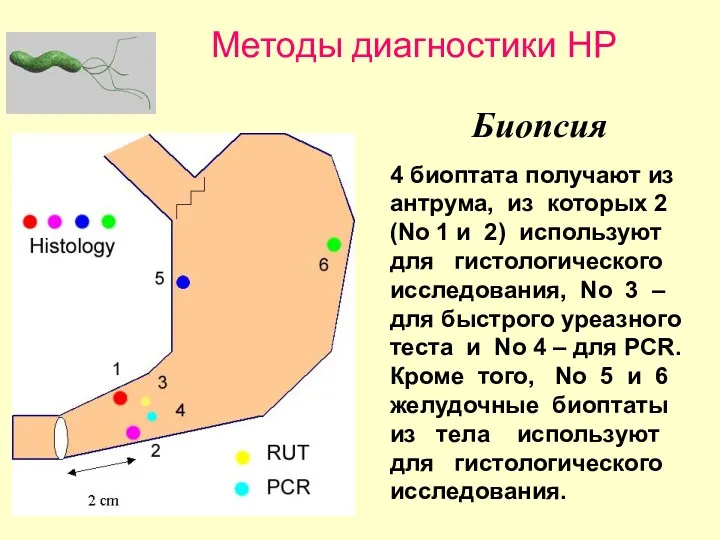 Биопсия 4 биоптата получают из антрума, из которых 2 (No