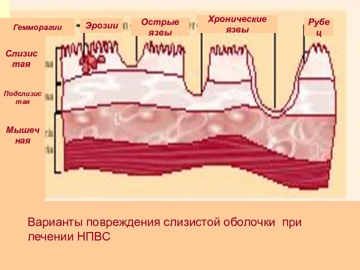 Варианты повреждения слизистой оболочки при лечении НПВС Гемморагии Эрозии Острые