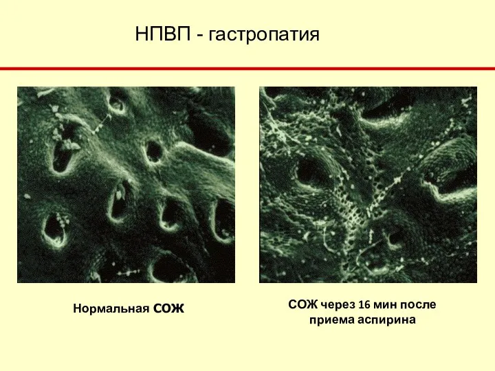НПВП - гастропатия СОЖ через 16 мин после приема аспирина Нормальная СОЖ