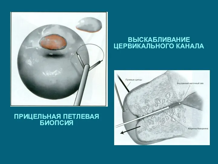 ПРИЦЕЛЬНАЯ ПЕТЛЕВАЯ БИОПСИЯ ВЫСКАБЛИВАНИЕ ЦЕРВИКАЛЬНОГО КАНАЛА