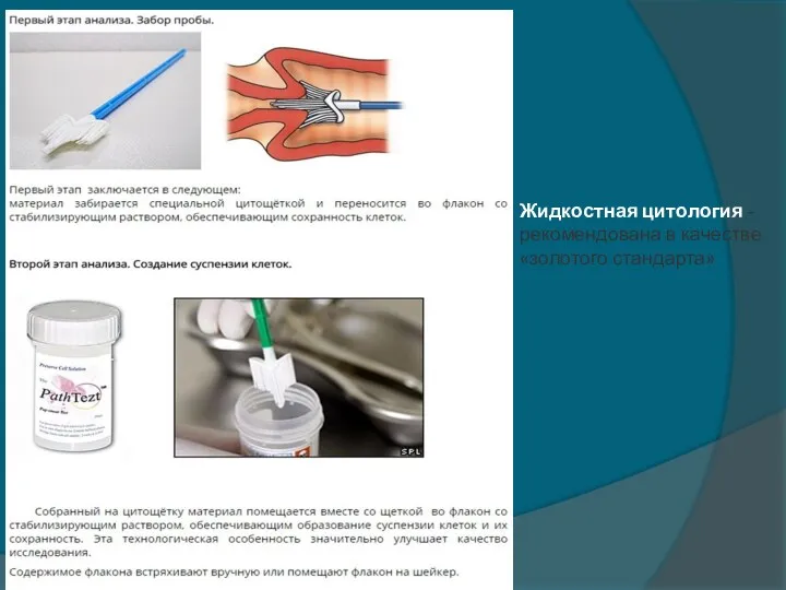 Жидкостная цитология - рекомендована в качестве «золотого стандарта»