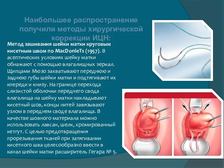Наибольшее распространение получили методы хирургической коррекции ИЦН: Метод зашивания шейки матки круговым кисетным