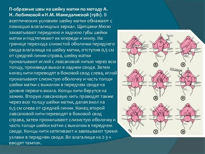 П-образные швы на шейку матки по методу А.И. Любимовой и Н.М. Мамедалиевой (1981).