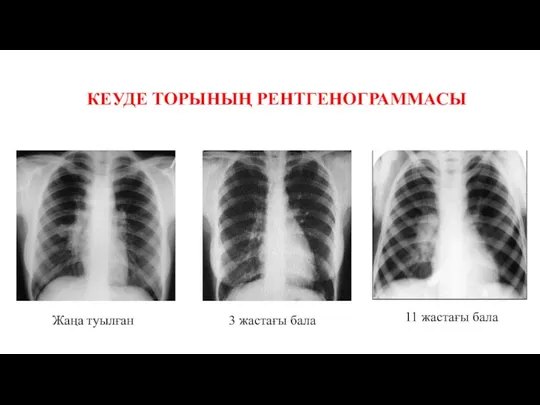 Жаңа туылған КЕУДЕ ТОРЫНЫҢ РЕНТГЕНОГРАММАСЫ 3 жастағы бала 11 жастағы бала