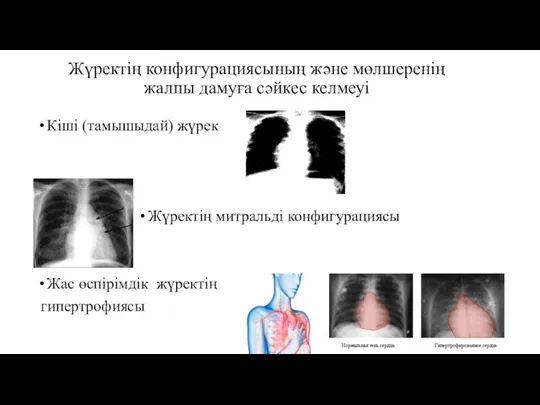 Жүректің конфигурациясының және мөлшеренің жалпы дамуға сәйкес келмеуі Кіші (тамышыдай) жүрек Жүректің митральді