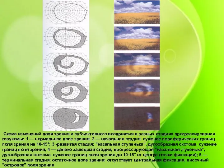 Схема изменений поля зрения и субъективного восприятия в разных стадиях прогрессирования глаукомы: 1