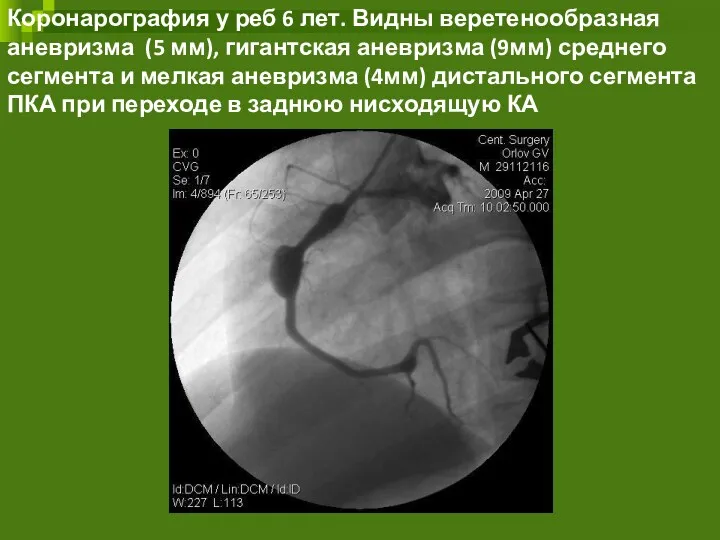 Коронарография у реб 6 лет. Видны веретенообразная аневризма (5 мм), гигантская аневризма (9мм)