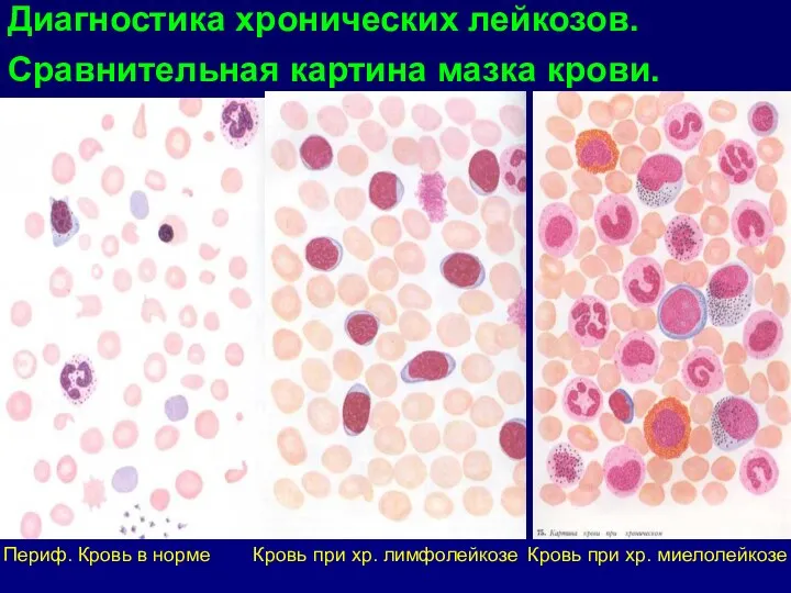 Диагностика хронических лейкозов. Сравнительная картина мазка крови. Периф. Кровь в