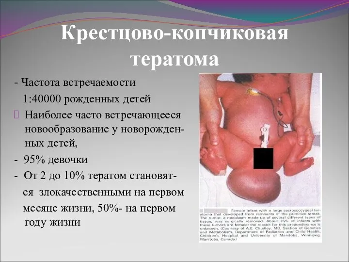 Крестцово-копчиковая тератома - Частота встречаемости 1:40000 рожденных детей Наиболее часто встречающееся новообразование у