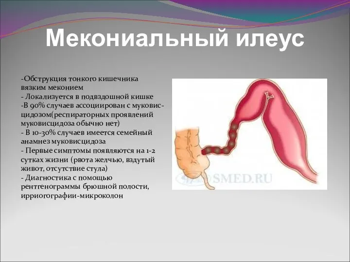 Мекониальный илеус -Обструкция тонкого кишечника вязким меконием - Локализуется в