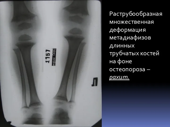 Раструбообразная множественная деформация метадиафизов длинных трубчатых костей на фоне остеопороза – рахит.