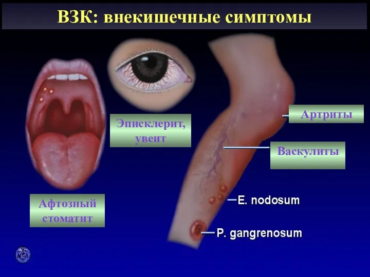 EXTRAINTESTINAL MANIFESTATIONS ВЗК: внекишечные симптомы Афтозный стоматит Эписклерит, увеит Васкулиты Артриты