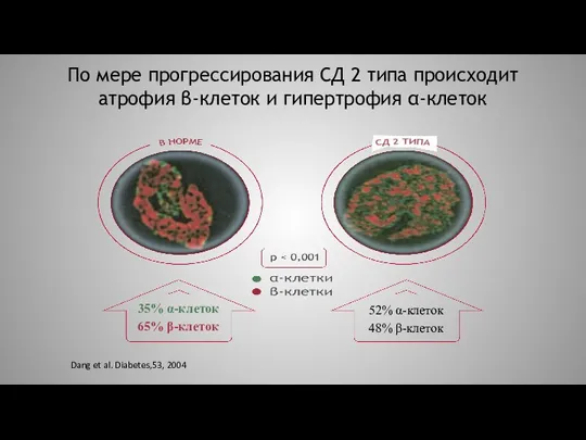 По мере прогрессирования СД 2 типа происходит атрофия β-клеток и